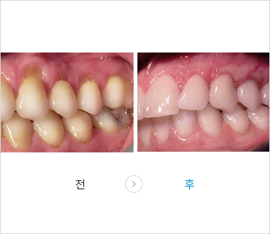 잇몸치료 이미지