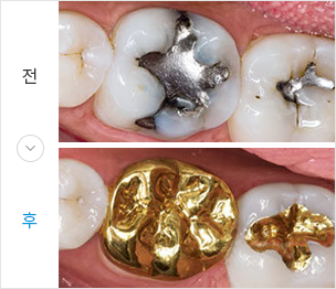 금치료 전후 이미지