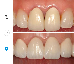 세라믹치료 전후 이미지