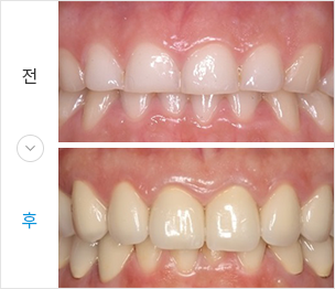 금속&세라믹 전후 치료 이미지