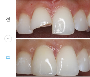 레진 전후 이미지
