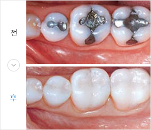 인레이 전후 이미지
